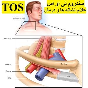 TOS-سندروم-خروجی-توراسیک-علائم-نشانه ها-درمان-فیزیوتراپی-دکتر-رضایی